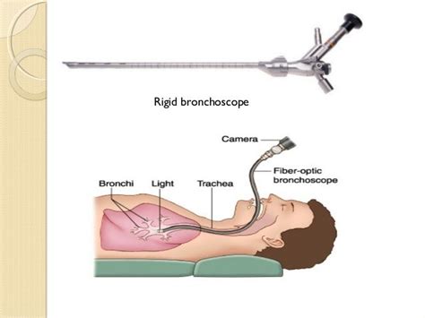 Bronchoscopy ppt