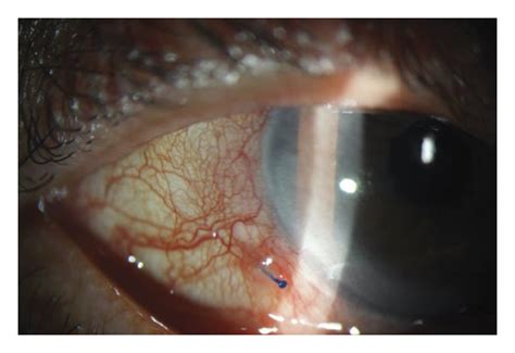 Complications after intrascleral fixation of intraocular lens by the... | Download Scientific ...