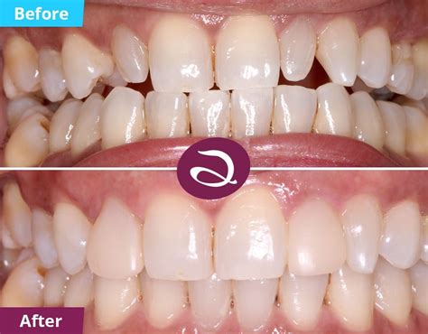 Composite Resin Veneers Before And After | Before And After