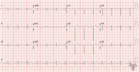 Poor R-wave Progression | ECG Stampede