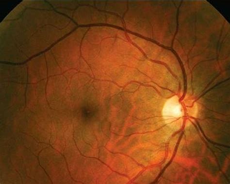 Optic Neuritis - Pictures, Symptoms, Causes, Diagnosis, Treatment