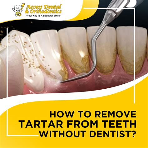 How to Remove Plaque & Tartar From Teeth (Without Dentist)