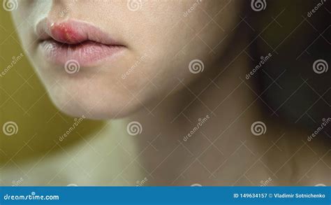 Herpes Simplex Virus on the Upper Lip of a Young Beautiful Woman. Stock Image - Image of ...