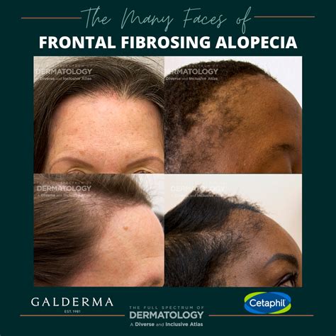 The Many Faces of Frontal Fibrosing Alopecia (FFA) - Next Steps in Dermatology