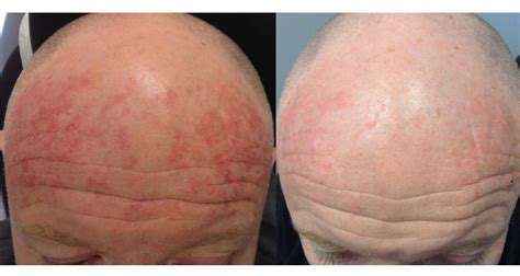 Before & After | DermAssociates Rockville | U.S. Dermatology Partners