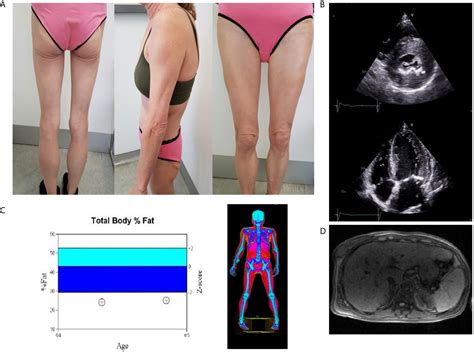 Frontiers | Case Report: Metreleptin Treatment in a Patient With a Novel Mutation for Familial ...