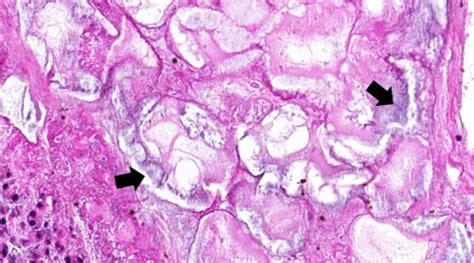 IPLab:Lab 1:Fat Necrosis - Pathology Education Instructional Resource