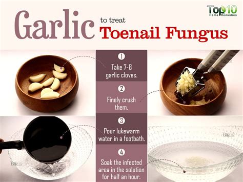 Home Remedies for Toenail Fungus | Top 10 Home Remedies