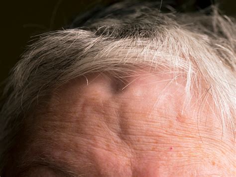 Indentations In Female Forehead Caused By A Craniotomy Stock Photo - Download Image Now - iStock