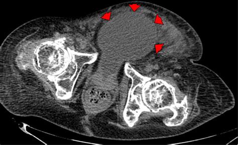 noncontrast Ct of kidneys and urinary bladder, performed on day 7 of... | Download Scientific ...