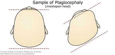 PLAGIOCEPHALY -FLATTENED HEAD - Care of Children