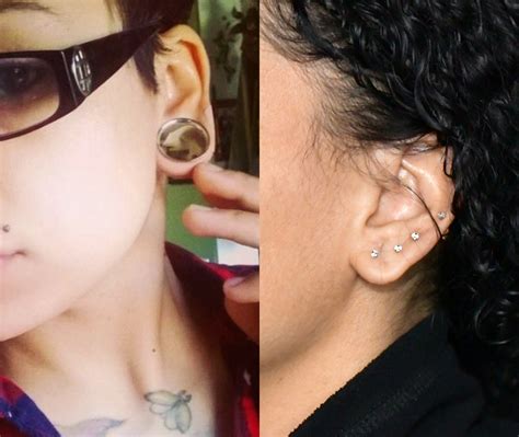 Before & After Photos Earlobe Repair 3 | NYC