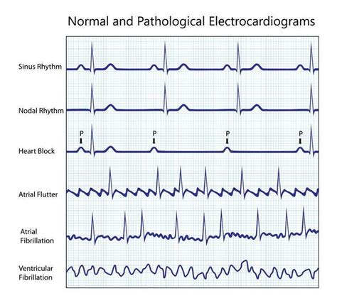 Pinterest | Heart blocks, Heart rhythms, Mnemonics