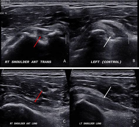 Popeye’s sign: biceps tendon rupture | BMJ Case Reports