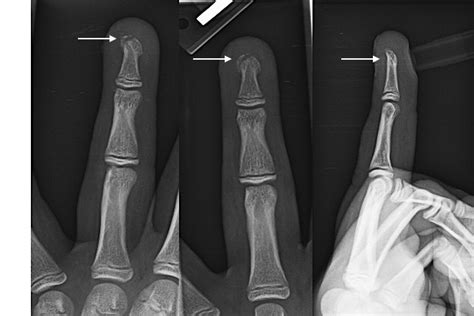 FINGER DISTAL PHALANX FRACTURE PEDIATRIC | Hand Surgery Resource