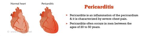 Pericarditis - Causes Symptoms and Signs Diagnosis Treatment