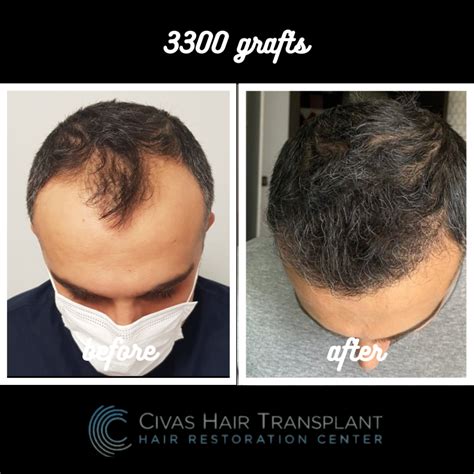 Civas Hair Transplant (Dr Ekrem Civas) -- 3300 grafts fue -- after 1 year | Hair loss Forum ...