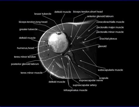 shoulder anatomy | mri shoulder axial anatomy | free cross sectional anatomy | | Shoulder ...