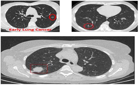 Benign Lung Tumor