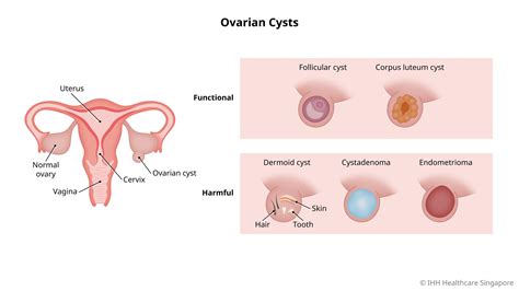 Ovarian Cysts - Symptoms & Causes | Parkway Shenton