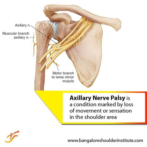 Axillary Nerve Impingement