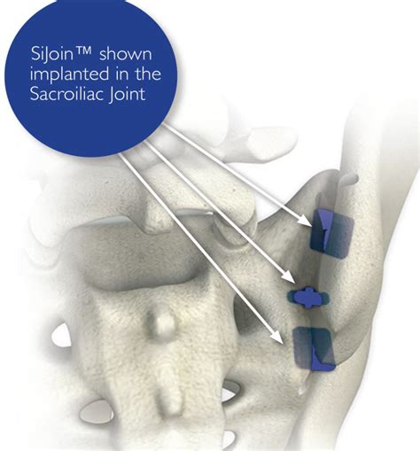 Sacroiliac Joint (SI) Dysfunction and Pain Treatment Procedure