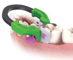 Triodent - Matrix System - Dentistry Today