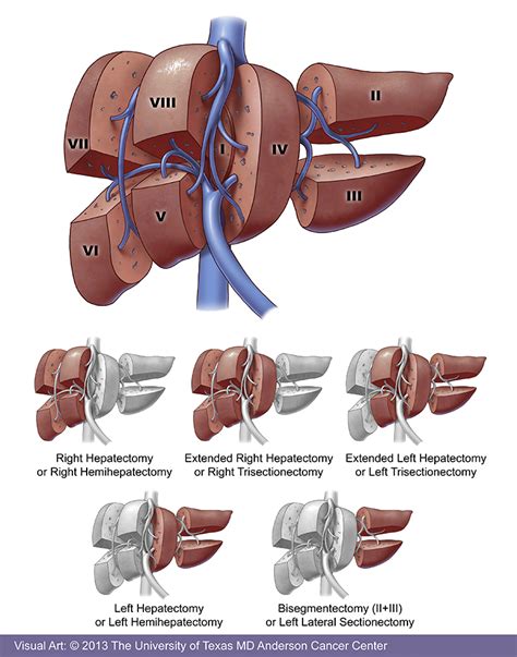 Liver Cancer Treatment | MD Anderson Cancer Center