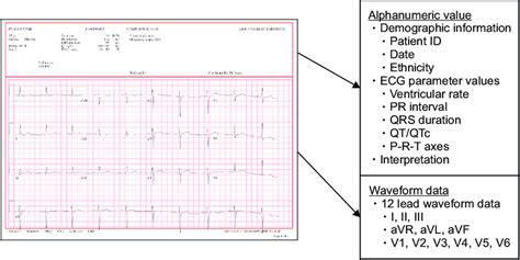 Example of an electrocardiogram (ECG) report. Alphanumeric values ...