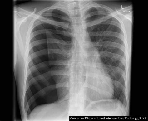 Hemo Pneumothorax X Ray