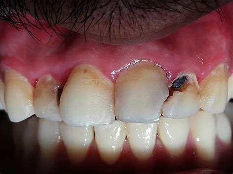 What Mal-aligned teeth can do... - Dr. Obaid's Dental Surgery