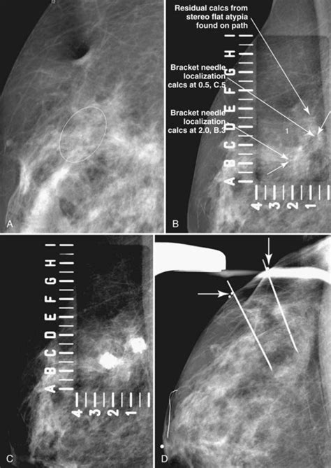 Mammographic and Ultrasound-Guided Breast Biopsy Procedures | Radiology Key