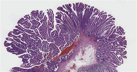 Tubular Adenoma Histology