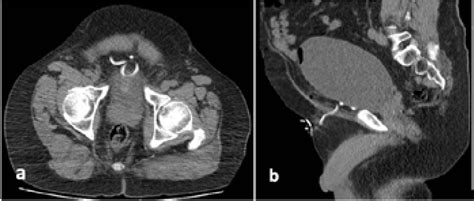 Figure 1 from Reliability of percutaneous suprapubic cystostomy catheter insertion and analysis ...