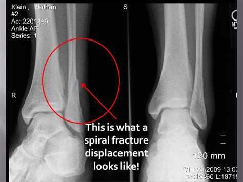 Fracture Of Fibula - Fracture Treatment