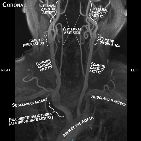 Gross Anatomy Glossary: Arteries - Head & Neck | Draw It to Know It