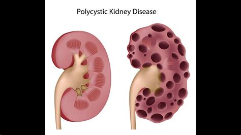 Polycystic Kidney Disease - YouTube