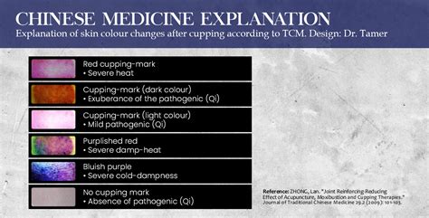 WHAT DO CUPPING MARKS COLOURS TELL YOU? - Sin Kang TCM