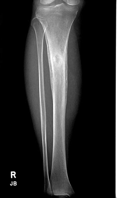 Brodie abscess | Radiology Case | Radiopaedia.org | Radiology, Radiology imaging, Medical imaging