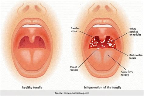 Tiny White Spots On Throat Not Strep