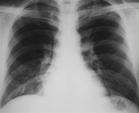 Mycoplasma Pneumonia