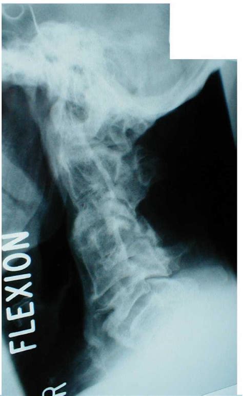 Lateral view of cervical spine shows congenital fusion of bodies of C2 ...