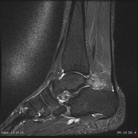 Posterior Ankle Impingement Mri