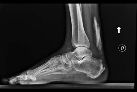 Achilles tendon ossification | Radiology Case | Radiopaedia.org