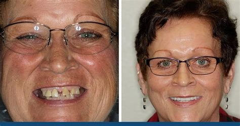 How Much Do Dentures Cost? | Aesthetic Dental Center | ☎ 701-214-5552