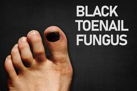 Black Nail Fungus Under Toenails Could a black spot under the toenail ...