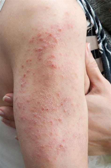 What is Dermatitis Herpetiformis? - Allergic Living