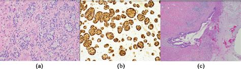 (a) Well-differentiated goblet cell carcinoma, present in submucosa ...