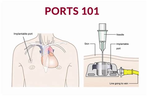 What To Know About PICC Lines and Ports | Cancer 101