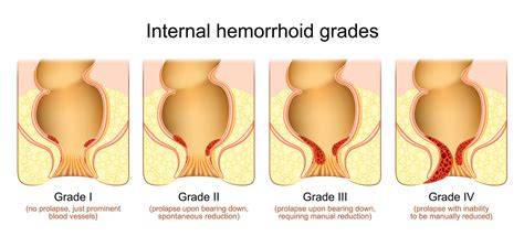 Hemorrhoids - Dr Neeraj Singh MD FACS FASCRS